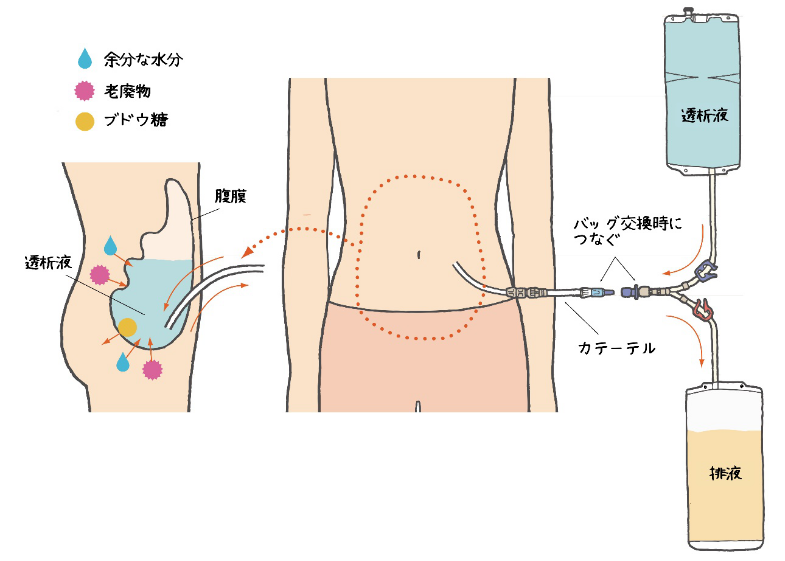 腹膜透析